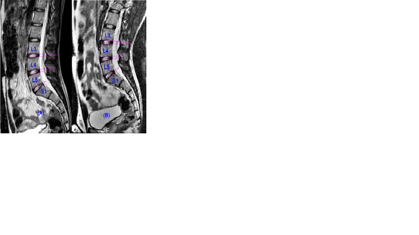 The measurements of the extent of lateral flexion at last three lower lumbar vertebrae during different lower lumbar spine positions (A) and (B)